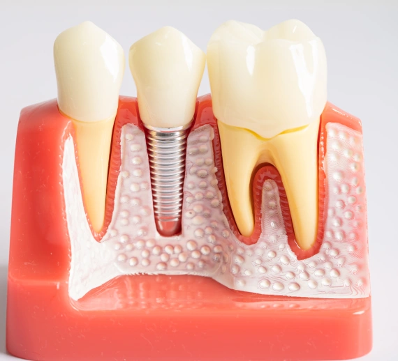Bone Grafting