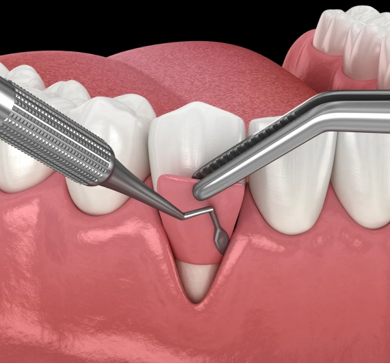 Connective Tissue Grafts