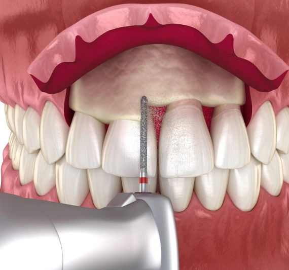 Crown Lengthening