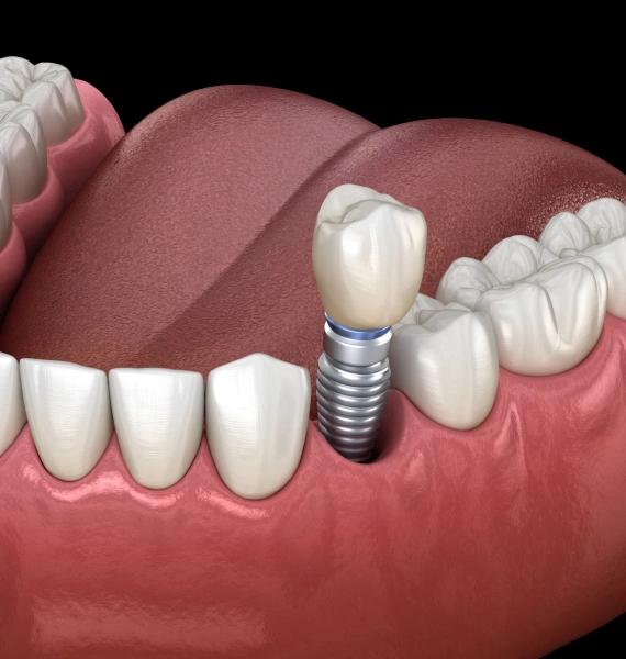 Dental Implants