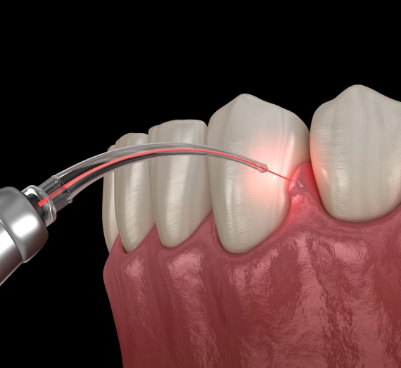 Laser Dentistry