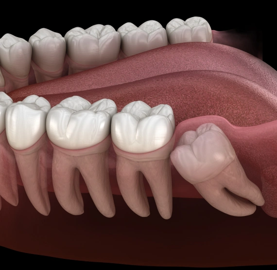Wisdom Tooth Extraction