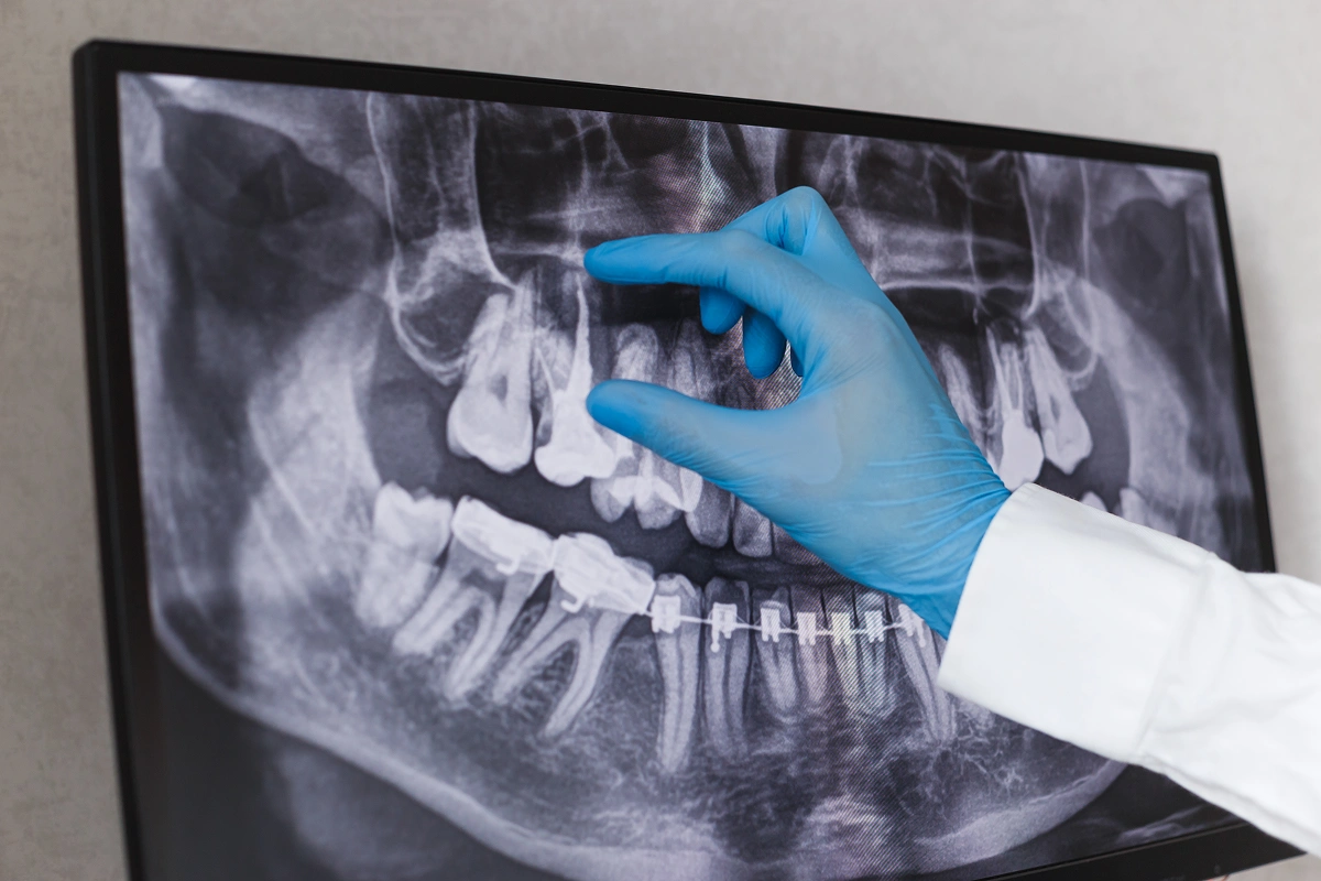 Wisdom Teeth Extraction: Myths and Facts You Need To Know