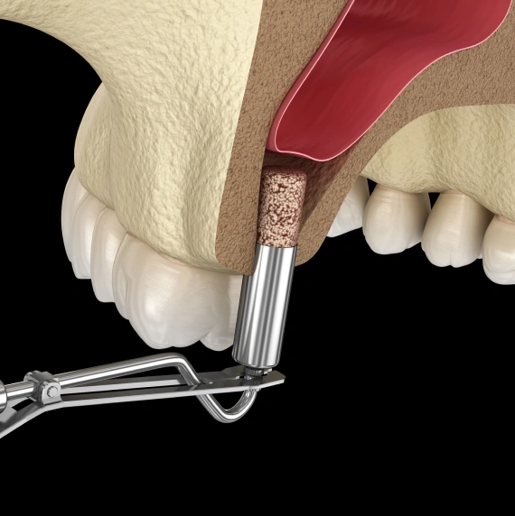 Sinus Lift
